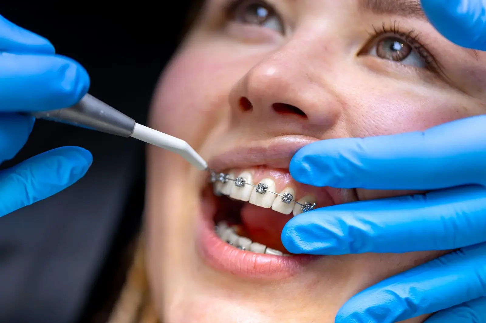 dental-procedure-for-installing-braces-close-up-dentistry-braces-on-the-teeth- (1)
